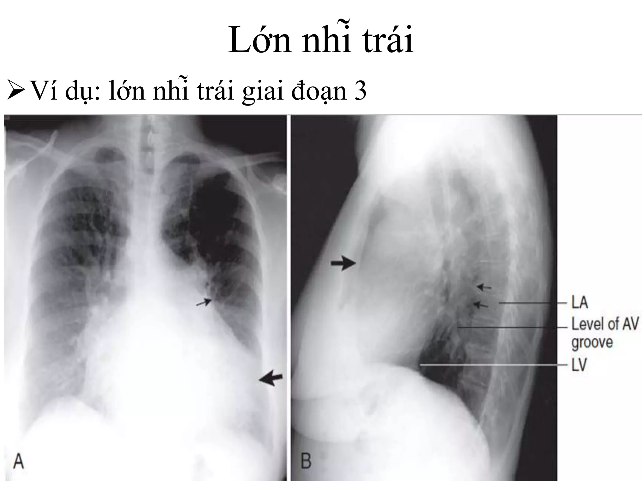 Các bất thường bóng tim trên xquang | PPTX