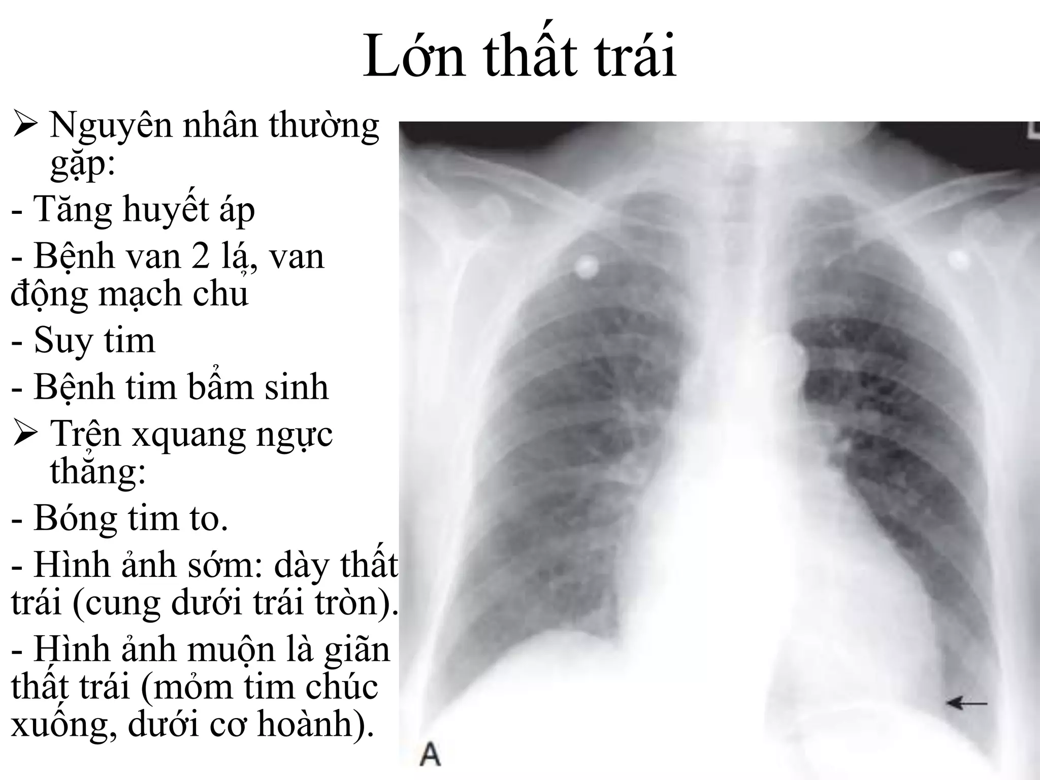Các bất thường bóng tim trên xquang | PPTX