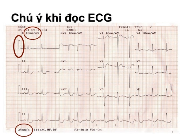 Các bước đọc điện tâm đồ ECG