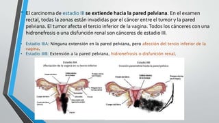 • El carcinoma de estadio III se extiende hacia la pared pelviana. En el examen
rectal, todas la zonas están invadidas por el cáncer entre el tumor y la pared
pelviana. El tumor afecta el tercio inferior de la vagina.Todos los cánceres con una
hidronefrosis o una disfunción renal son cánceres de estadio III.
• Estadio IIIA: Ninguna extensión en la pared pelviana, pero afección del tercio inferior de la
vagina.
• Estadio IIIB: Extensión a la pared pelviana, hidronefrosis o disfunción renal.
 