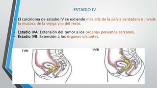 ESTADIO IV
• El carcinoma de estadio IV se extiende más allá de la pelvis verdadera o invade
la mucosa de la vejiga y/o del recto.
• Estadio IVA: Extensión del tumor a los órganos pelvianos cercanos.
• Estadio IVB: Extensión a los órganos distantes.
 