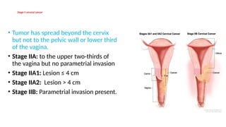 Stage II cervical cancer
• Tumor has spread beyond the cervix
but not to the pelvic wall or lower third
of the vagina.
• Stage IIA: to the upper two-thirds of
the vagina but no parametrial invasion
• Stage IIA1: Lesion ≤ 4 cm
• Stage IIA2: Lesion > 4 cm
• Stage IIB: Parametrial invasion present.
 