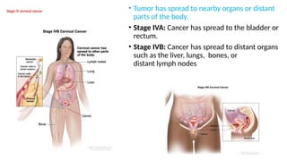 Stage IV cervical cancer • Tumor has spread to nearby organs or distant
parts of the body.
• Stage IVA: Cancer has spread to the bladder or
rectum.
• Stage IVB: Cancer has spread to distant organs
such as the liver, lungs, bones, or
distant lymph nodes
 