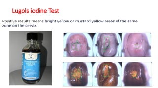 Lugols iodine Test
Positive results means bright yellow or mustard yellow areas of the same
zone on the cervix.
 