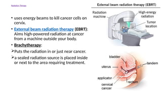 Radiation Therapy
• uses energy beams to kill cancer cells on
cervix.
• External beam radiation therapy (EBRT):
Aims high-powered radiation at cancer
from a machine outside your body.
• Brachytherapy:
Puts the radiation in or just near cancer.
a sealed radiation source is placed inside
or next to the area requiring treatment.
 