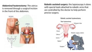 Abdominal hysterectomy: The uterus
is removed through a surgical incision
in the front of the abdomen.
Robotic-assisted surgery: the laparoscopy is done
with special tools attached to robotic arms that
are controlled by the doctor to help perform
precise surgery.
 