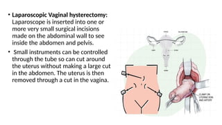 • Laparoscopic Vaginal hysterectomy:
Laparoscope is inserted into one or
more very small surgical incisions
made on the abdominal wall to see
inside the abdomen and pelvis.
• Small instruments can be controlled
through the tube so can cut around
the uterus without making a large cut
in the abdomen. The uterus is then
removed through a cut in the vagina.
 