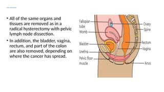 Pelvic Exenteration
• All of the same organs and
tissues are removed as in a
radical hysterectomy with pelvic
lymph node dissection.
• In addition, the bladder, vagina,
rectum, and part of the colon
are also removed, depending on
where the cancer has spread.
 