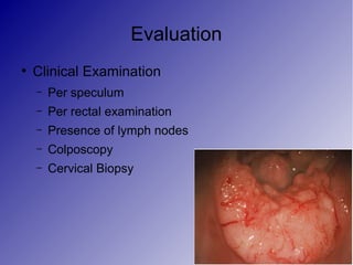 Evaluation
●
Clinical Examination
– Per speculum
– Per rectal examination
– Presence of lymph nodes
– Colposcopy
– Cervical Biopsy
 