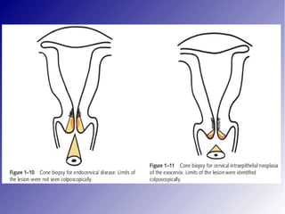 Ca cervix evaluation and staging