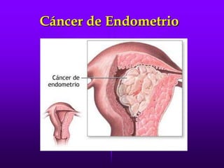 Cancer  Cervix