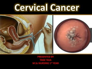 Cervical Cancer
PRESENTED BY
TAGE YAJA
M.Sc NURSING 1st YEAR
 