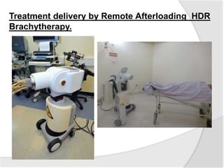 Treatment delivery by Remote Afterloading HDR
Brachytherapy.
 