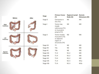 Stage 
Primary Tumor 
(T) 
Regional Lymph 
Node (N) 
Remote 
Metastasis (M) 
Stage 0 Carcinoma in 
situ (Tis) 
N0 M0 
Stage I Tumor may 
invade 
submucosa (T1) 
or muscularis 
propria (T2) 
N0 M0 
Stage II Tumor invades 
muscularis (T3) 
or adjacent 
organs or 
structures (T4) 
N0 M0 
Stage IIA T3 N0 M0 
Stage IIB T4a N0 M0 
Stage IIC T4b N0 M0 
Stage IIIA T1-4 N1-2 M0 
Stage IIIB T1-4 N1-2 M0 
Stage IIIC T3-4 N1-2 M0 
Stage IVA T1-4 N1-3 M1a 
Stage IVB T1-4 N1-3 M1b 
 