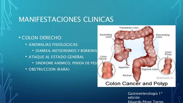 Ca colon Ca colon