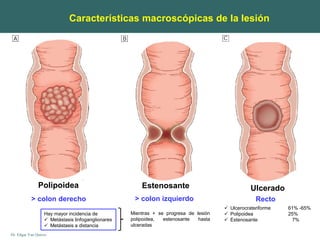 Dr. Edgar Yan Quiroz
Estenosante Ulcerado
Polipoidea
> colon derecho > colon izquierdo
Características macroscópicas de la lesión
Hay mayor incidencia de
 Metástasis linfoganglionares
 Metástasis a distancia
Recto
 Ulcerocrateriforme 61% -65%
 Polipoidea 25%
 Estenosante 7%
Mientras + se progresa de lesión
polipoidea, estenosante hasta
ulceradas
 