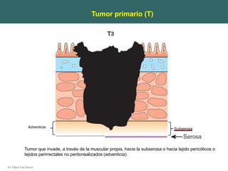 Dr. Edgar Yan Quiroz
Adventicia
Tumor que invade, a través de la muscular propia, hacia la subserosa o hacia tejido pericólicos o
tejidos perirrectales no peritonealizados (adventicia)
Subserosa
Tumor primario (T)
 