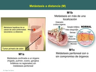 Dr. Edgar Yan Quiroz
Metástasis a distancia (M)
M1a
M1c
Metástasis peritoneal con o
sin compromiso de órganos
Metástasis confinada a un órgano
(hígado, pulmón, ovario, ganglios
linfáticos no regionales) sin
metástasis peritoneal
M1b
Metástasis en más de una
localización
 