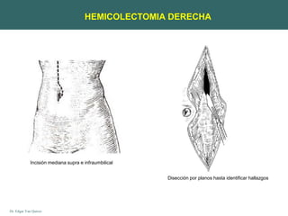 Dr. Edgar Yan Quiroz
Incisión mediana supra e infraumbilical
Disección por planos hasta identificar hallazgos
HEMICOLECTOMIA DERECHA
 
