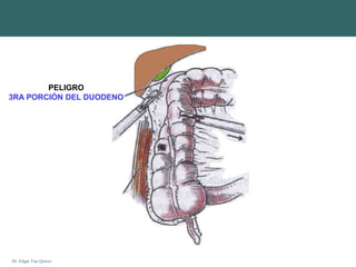 Dr. Edgar Yan Quiroz
PELIGRO
3RA PORCIÓN DEL DUODENO
 