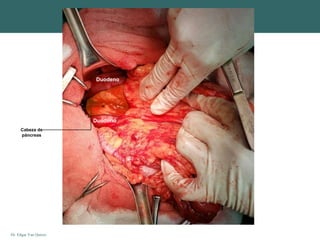 Dr. Edgar Yan Quiroz
Duodeno
Duodeno
Cabeza de
páncreas
 