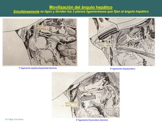 Dr. Edgar Yan Quiroz
Movilización del ángulo hepático
Simultáneamente se ligan y dividen los 3 planos ligamentosos que fijan al ángulo hepático
1º ligamento epiplocoloparietal derecho 2º ligamento hepatocólico
3º ligamento frenocólico derecho
 