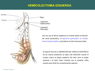 Dr. Edgar Yan Quiroz
Bazo
Ligamento
esplenocólico
Ligamento
frenocólico
Estómago
Páncreas
Una vez que la flexura esplénica se moviliza desde la dirección
del canal parietocólico, el ligamento gastrocólico es dividido
hacia el ángulo esplénico para liberar el colon transverso distal.
HEMICOLECTOMIA IZQUIERDA
El aspecto final de la LIBERACIÓN DEL ÁNGULO ESPLÉNICO
de los anexos posteriores se logra más fácilmente cuando el
cirujano coloca el ángulo esplénico del colon entre el pulgar
izquierdo y el dedo índice mientras que el asistente utiliza
cauterio para dividir los compartimientos adjuntos
 