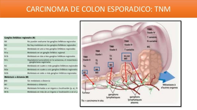 Ca colon Ca colon