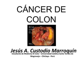 CÁNCER DE
       COLON


Jesús A. Custodio Marroquín
Estudiante de Medicina IX Ciclo – Universidad Católica Santo Toribio de
                    Mogrovejo – Chiclayo - Perú
 