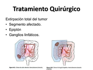 Tratamiento Quirúrgico
Extirpación total del tumor
• Segmento afectado.
• Epiplón
• Ganglios linfáticos.
 