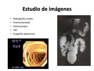 Estudio de imágenes
•   Radiografía simple
•   Enema baritado
•   Colonoscopía
•   TAC
•   Ecografía abdominal
 
