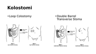 Simple Loop Colostomy Ca colon muhammad sobri maulana | PDF