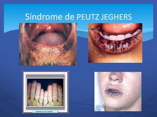 Síndrome de PEUTZ JEGHERS
 