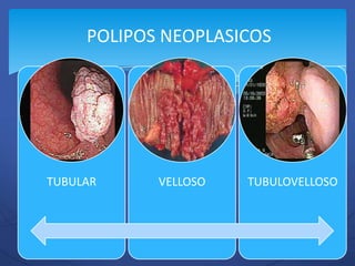 POLIPOS NEOPLASICOS




TUBULAR     VELLOSO   TUBULOVELLOSO
 