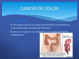 CANCER DE COLON

 COLONOSCOPIA
Se introduce aire en el colon para dilatarlo y permitir así
 el paso del tubo a través del intestino.
El proceso requiere una sedación, y se realiza de forma
 ambulatoria.
 