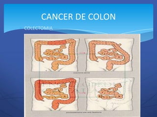CANCER DE COLON
COLECTOMIA
 