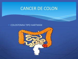 CANCER DE COLON


COLOSTOMIA TIPO HARTMAN
 