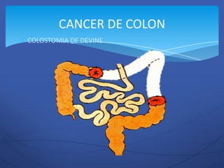 CANCER DE COLON
COLOSTOMIA DE DEVINE
 