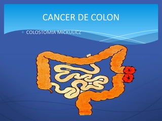 CANCER DE COLON
COLOSTOMIA MICKULICZ
 