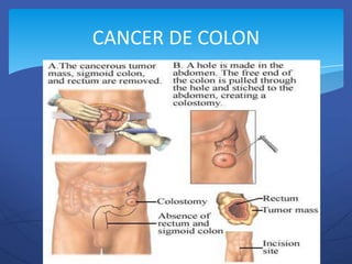 CANCER DE COLON
 