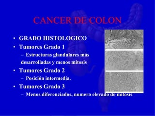 CANCER DE COLON
• GRADO HISTOLOGICO
• Tumores Grado 1
– Estructuras glandulares más
desarrolladas y menos mitosis
• Tumores Grado 2
– Posición intermedia.
• Tumores Grado 3
– Menos diferenciados, numero elevado de mitosis
 