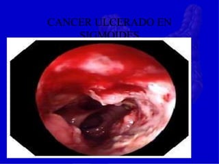 CANCER ULCERADO EN
SIGMOIDES
 