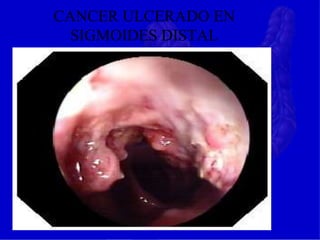 CANCER ULCERADO EN
SIGMOIDES DISTAL
 