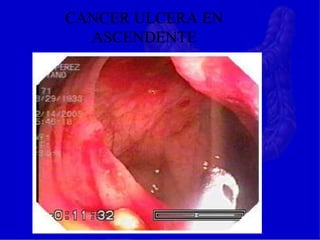 CANCER ULCERA EN
ASCENDENTE
 