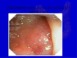 ESTENOSIS MALIGNA EN ANGULO
HEPATICO
 
