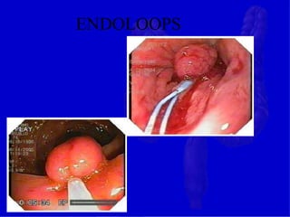 ENDOLOOPS
 
