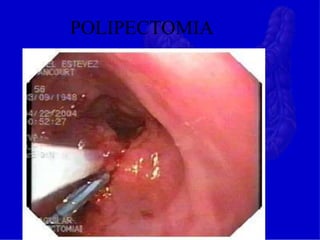 POLIPECTOMIA
 