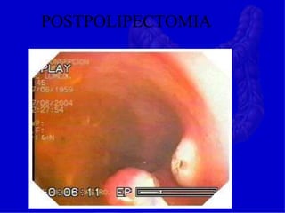 POSTPOLIPECTOMIA
 