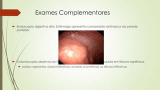 Exames Complementares
 Endoscopia digestiva alta: Estômago apresenta compressão extrínseca da parede
posterior.
 Colonoscopia observou-se tumoração vegetante e multilobulada em flexura esplênica.
 Lesões vegetantes, úlcero-infiltrativas, anulares (constritivas) ou difusos-infiltrativas
 