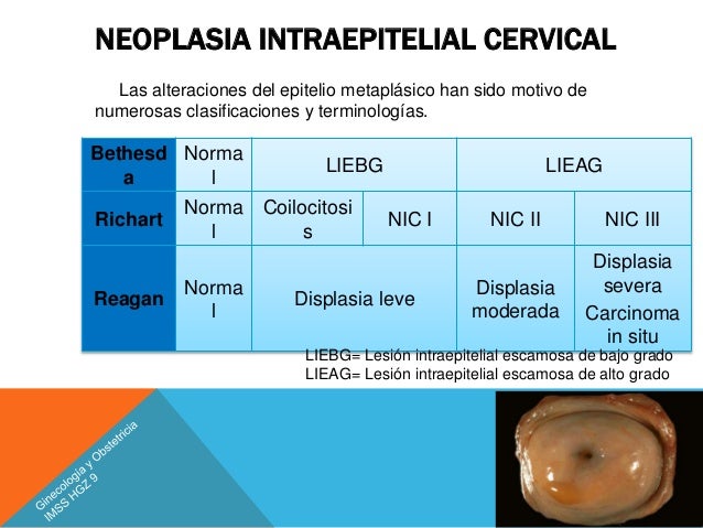 Cancer Cervicouterino